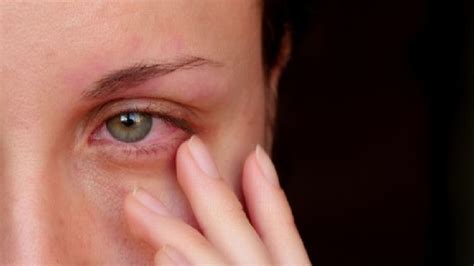 Eye Irritation Causes Diagnosis And Treatment