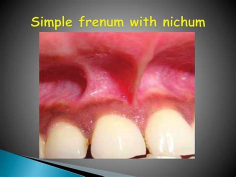 Aberrant Frenum And Its Treatment