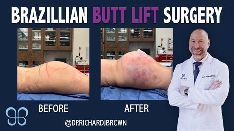 Brazilian Butt Lift Surgery And Pre Op Example Brown Plastic Surgery Youtube
