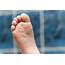 Trench Foot The Causes And Healthy Prevention  DermalMedix