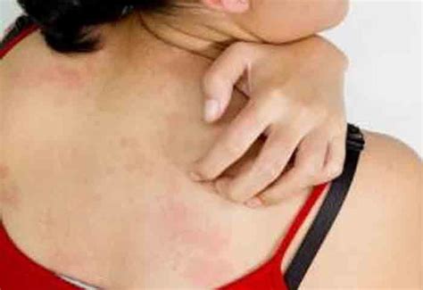 Want To Know How To Get Rid Of Back Acne Here Are