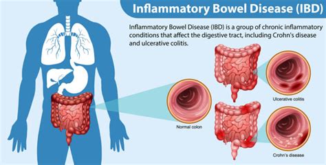 Inflammatory Bowel Disease Ibd Types Symptoms And Management