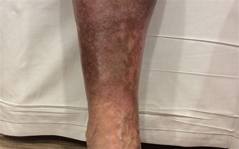 Lower Leg Discoloration What Does It Mean Totality