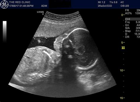 Detailed Scan In Pregnancy The Red Clinic