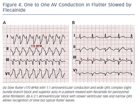 Atrial Flutter Typical And Atypical A Review Aer Journal