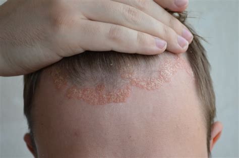 Dermatite Seborroica Come Si Cura Con I Rimedi Naturali Sexiz Pix
