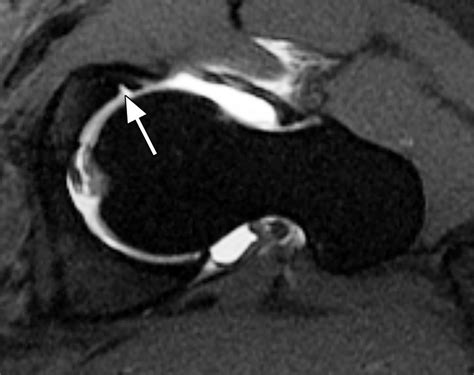 Partial Thickness Undersurface Anterior Labral Tear In A 46 Yearold
