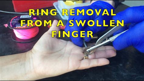 Rescue Removing A Ring From A Swollen Finger Youtube
