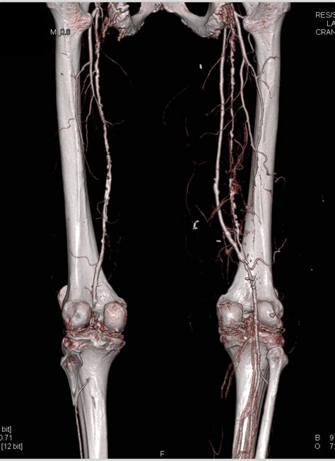 Peripheral Vascular Disease Pvd With Extensive Left Superficial