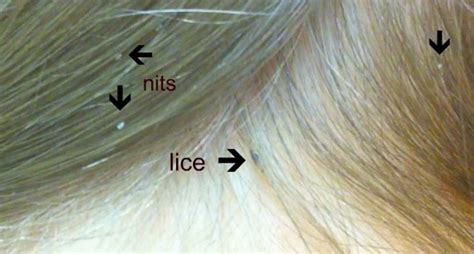 How Can You Tell If You Have Body Lice Mastery Wiki