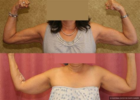 Upper Arm Lipo Before And After Doctorvisit