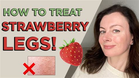 how to treat strawberry legs and why it happens dr sam bunting youtube