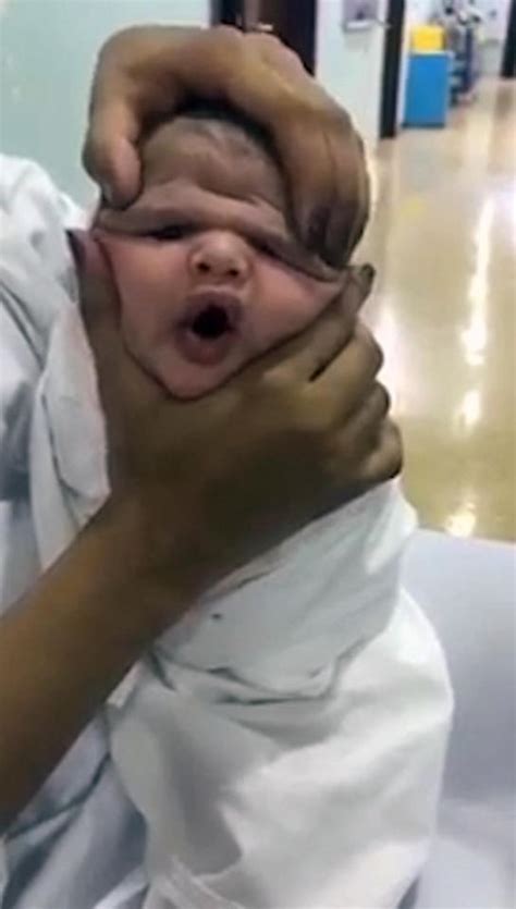 Nurses Made Fun Of The New Born Baby By Squeezing His Head