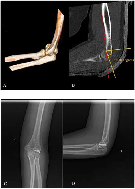 Humeral Capitellum Fracture Combined With Humeral Lateral Column Injury