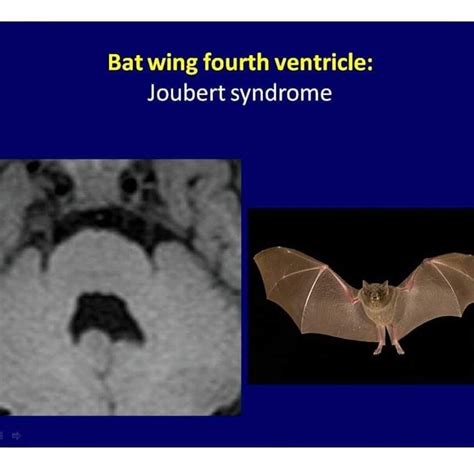 Joubert Syndrome Bat Wing Fourth Ventricle Medical Knowledge Medical