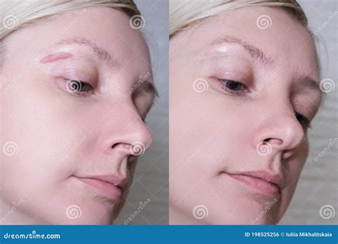 Hypertrophic Keloid Scar On Woman Face Before And After Laser Treatment