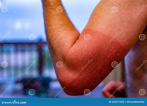Arm With Visible Red Sunburn Caused By Wearing A Shirt Stock Image
