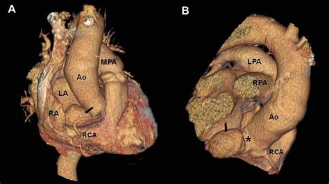 Ruptured Aneurysm Of The Sinus Of Valsalva Presenting With Ventricular