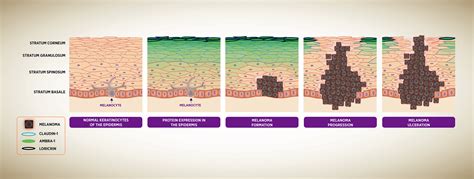 Fico 28 Fatti Su Melanoma Stages Of Skin Cancer Accre