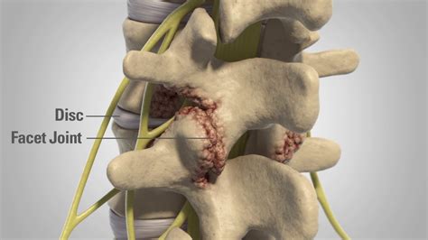 Patient Education Lumbar Degenerative Disc Disease Youtube