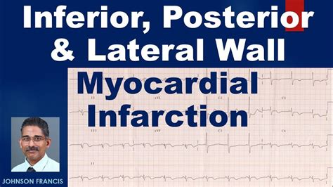 Inferior Posterior And Lateral Wall Myocardial Infarction Youtube