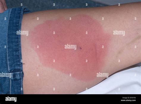 Mrsa Skin Infection Immagini E Fotografie Stock Ad Alta Risoluzione Alamy