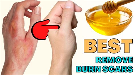 How To Remove Burn Scars From Face And Skin Natural Scar Removal Lotion