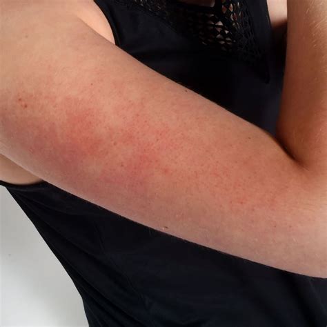 Dark Red Spots On Arm