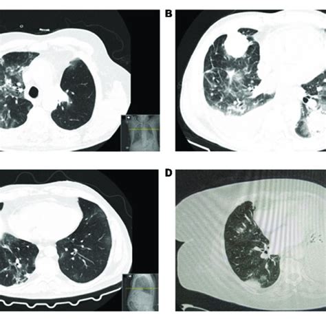Patients Chest Ct Scans A Bilateral Predominantly Peripheral