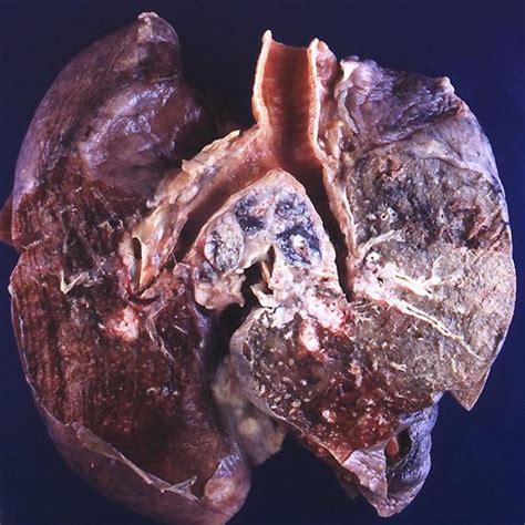 Small Cell Lung Cancer Gross Pathology Radiology Case