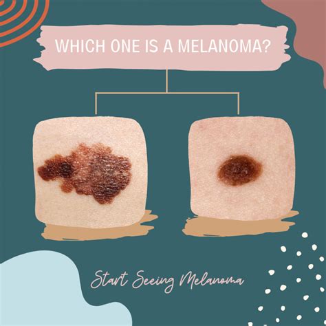 Melanoma Zohebamaryss