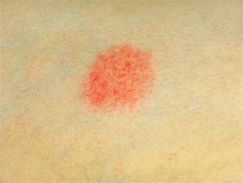 Dermatitis Numularis Gejala Penyebab Dan Mengobati Alodokter