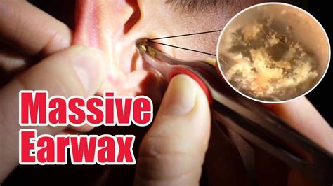 Massive Earwax Removal Part 1 It Looks Like An Insect Youtube