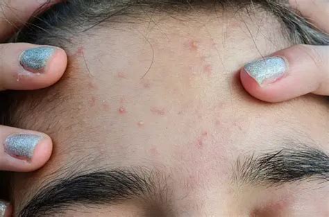 Isotretinoin Treatment For Acne Schweiger Dermatology Group