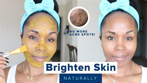 How To Brighten Skin Reduce Acne Scars Hyperpigmentation