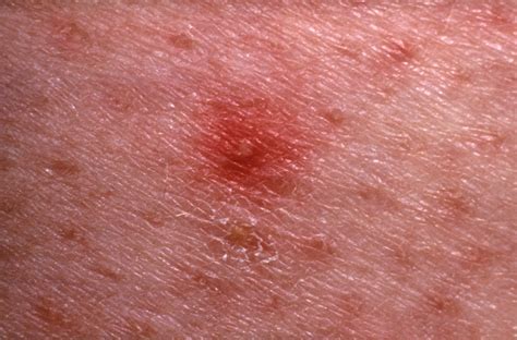 7 Causes Of Red Spots And Bumps On Skin With Pictures Allure