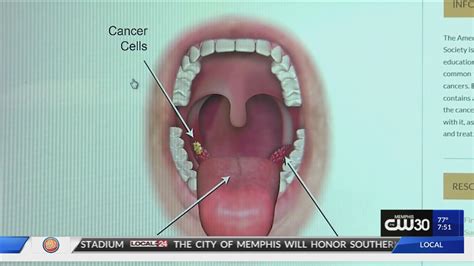 Mouth cancer, also known as oral cancer, is where a tumour develops in a part of the mouth. LOCAL HEALTH ALERT: HPV directly related to Throat Cancer ...