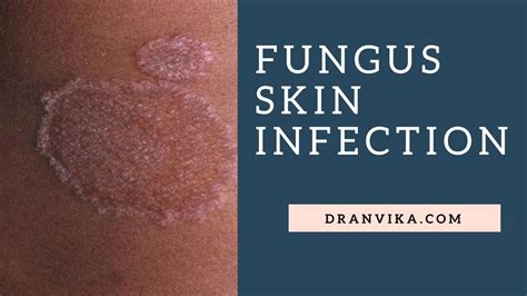 Fungus Infection Of Skin Treatment Dr Anvika Youtube