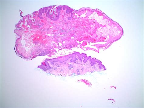 Pathology Outlines Cutaneous Fibroepithelial Polyps
