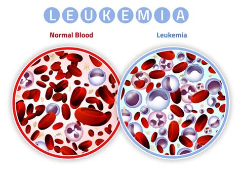 Leukemia Illustrations Royalty Free Vector Graphics And Clip Art Istock