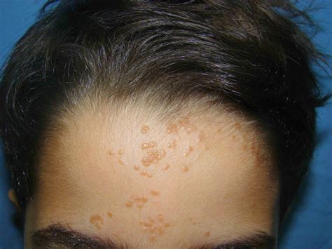 Photos Of Warts On Face How To Remove Moles Warts Skin Tags Safely