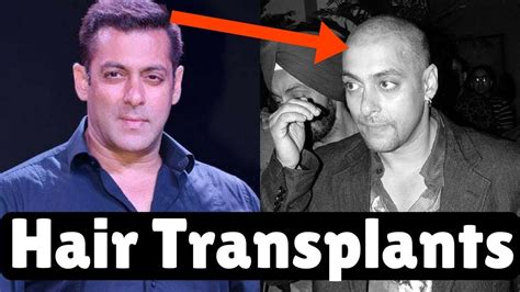 Top 8 Bollywood Star Who Went For Hair Transplants Surgery Hair