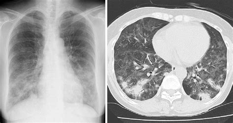 Figure Chest Radiograph And Computed Tomography Scan Showing Free