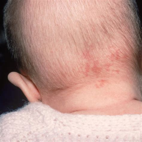 Must Know About Small Bump On Baby Head Most Popular City Of Hot