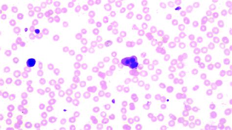 Peripheral Film Showing Platelet Anisocytosis And Clumping Download