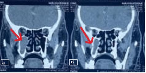 Cureus Aspergillosis Of Maxillary Sinus S Diagnosis Management And