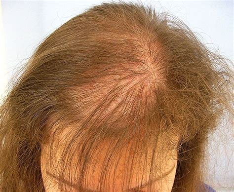 Hair loss, known medically as alopecia, is fairly common. Hair Loss Treatment for women in Lahore
