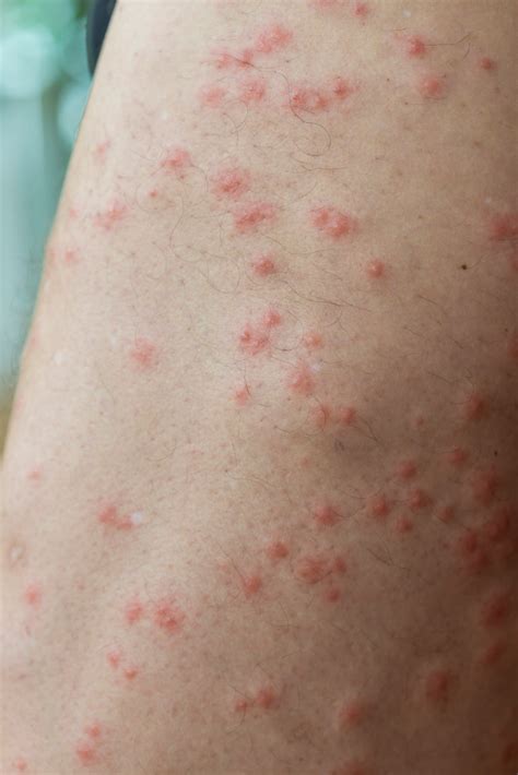 These Pictures Will Help You Id The Most Common Bug Bites This Summer Tick Bite Rash Bed Bug