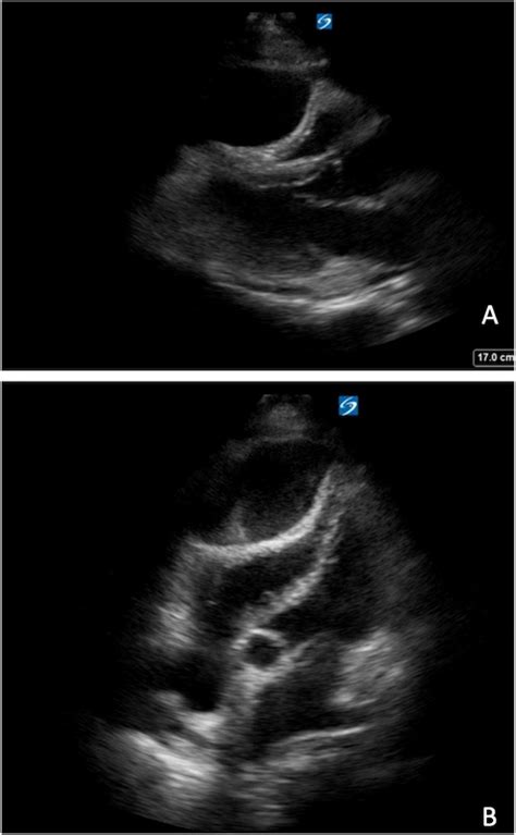 Point Of Care Ultrasound Pocus Demonstrating Right Ventricular