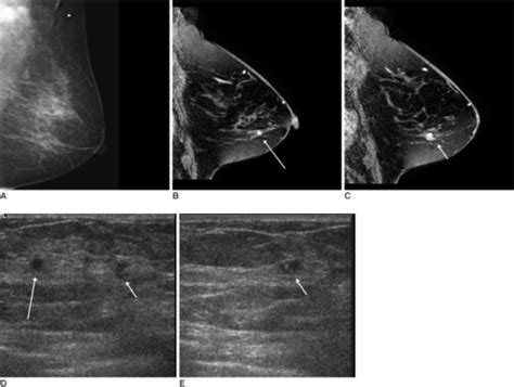 Figure 1breast Mri For Evaluating Patients With Metastatic Axillary